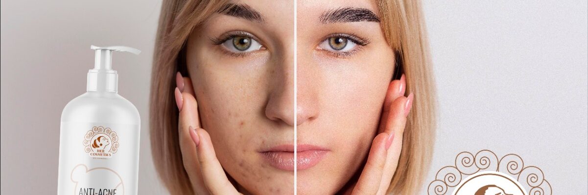 How Can We Effectively Fight Acne by Following These Steps